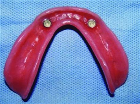 zirca metal housing attachments denture|Nationwide Experts in Fixed.